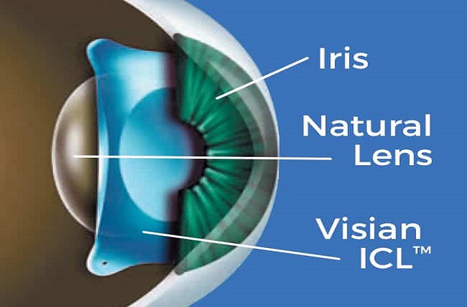 Know About ICL Vision Surgery